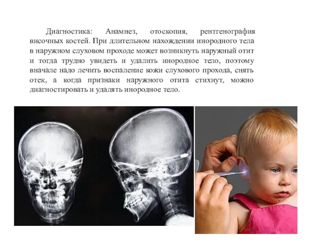Диагностика: Анамнез, отоскопия, рентгенография височных костей. При длительном нахождении инородного