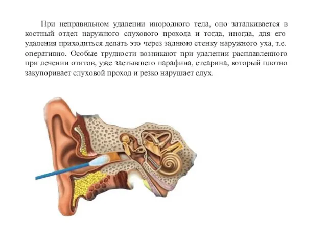 При неправильном удалении инородного тела, оно заталкивается в костный отдел