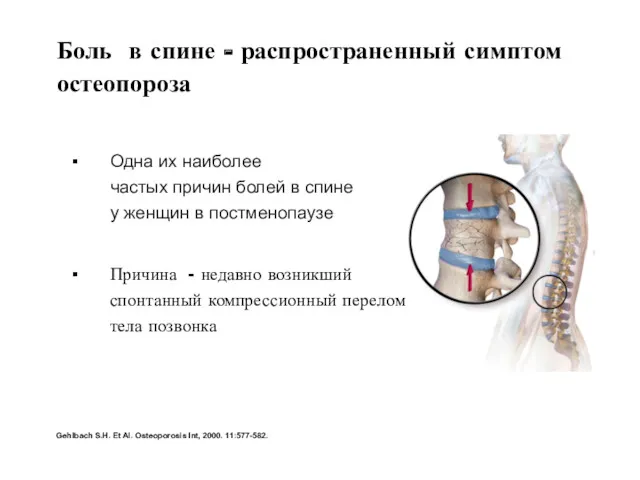 Боль в спине - распространенный симптом остеопороза Одна их наиболее частых причин болей