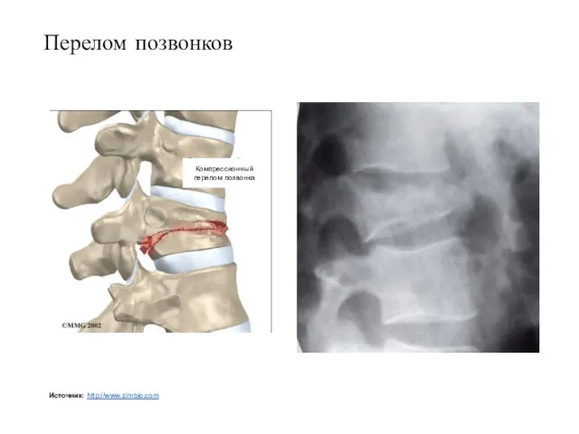 Перелом позвонков Компрессионный перелом позвонка Источник: http://www.zimbio.com