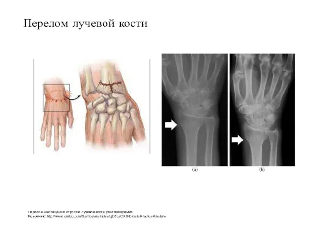 Перелом лучевой кости Перелом шиловидного отростка лучевой кости, рентгенограмма Источник: http://www.zimbio.com/Samloyal/articles/LjD1LsCX1N0/distal+radius+fracture