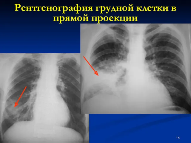 Рентгенография грудной клетки в прямой проекции