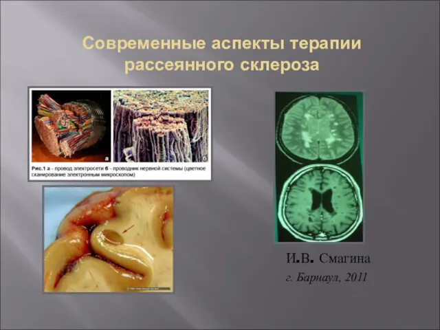 Современные аспекты терапии рассеянного склероза