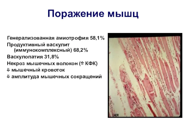 Поражение мышц Генерализованная амиотрофия 58,1% Продуктивный васкулит (иммунокомплексный) 68,2% Васкулопатия 31,8% Некроз мышечных