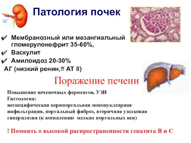 Патология почек Мембранозный или мезангиальный гломерулонефрит 35-60%, Васкулит Амилоидоз 20-30% АГ (низкий ренин,⇑