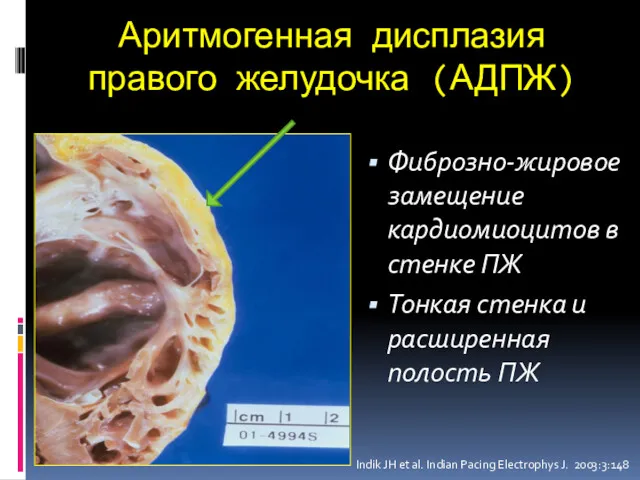 Аритмогенная дисплазия правого желудочка (АДПЖ) Фиброзно-жировое замещение кардиомиоцитов в стенке