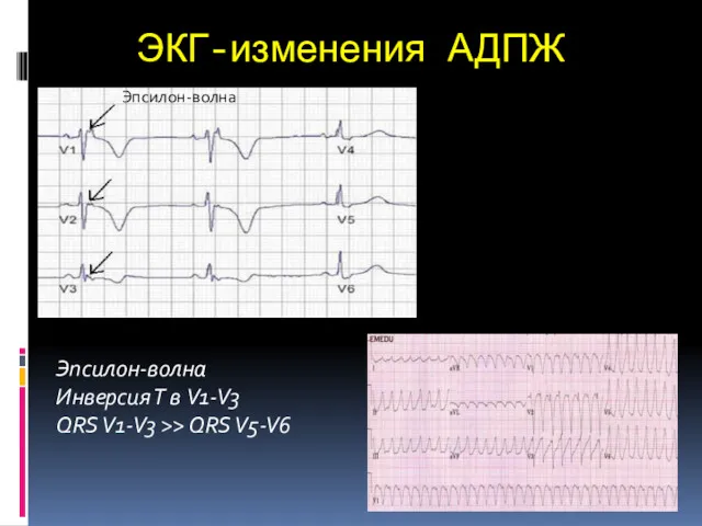 ЭКГ-изменения АДПЖ Эпсилон-волна Эпсилон-волна Инверсия Т в V1-V3 QRS V1-V3 >> QRS V5-V6