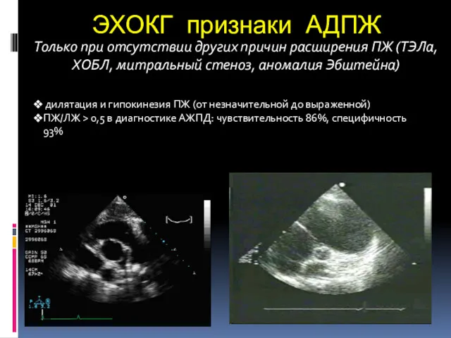 ЭХОКГ признаки АДПЖ Только при отсутствии других причин расширения ПЖ