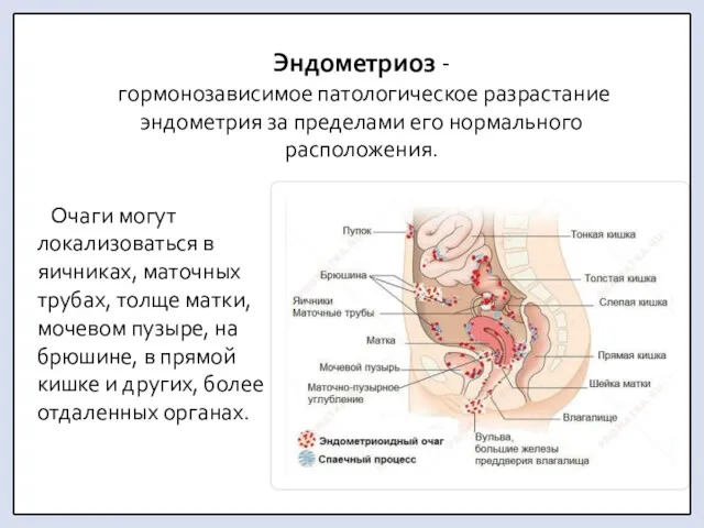 Эндометриоз - гормонозависимое патологическое разрастание эндометрия за пределами его нормального расположения. Очаги могут