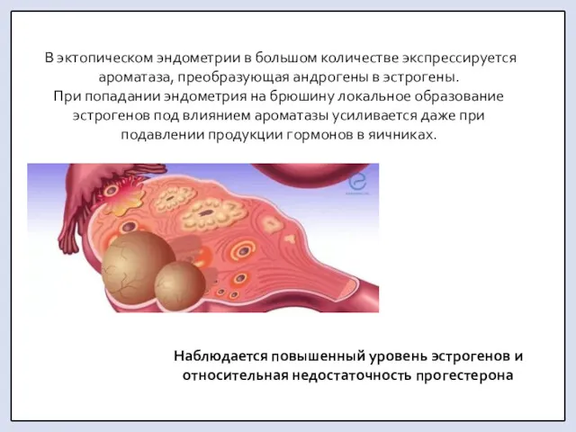 В эктопическом эндометрии в большом количестве экспрессируется ароматаза, преобразующая андрогены