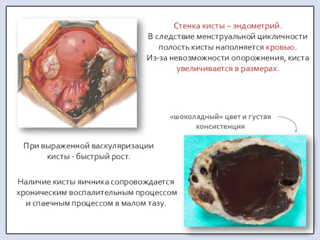 Стенка кисты – эндометрий. В следствие менструальной цикличности полость кисты наполняется кровью. Из-за