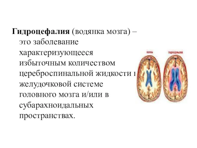 Гидроцефалия (водянка мозга) – это заболевание характеризующееся избыточным количеством цереброспинальной