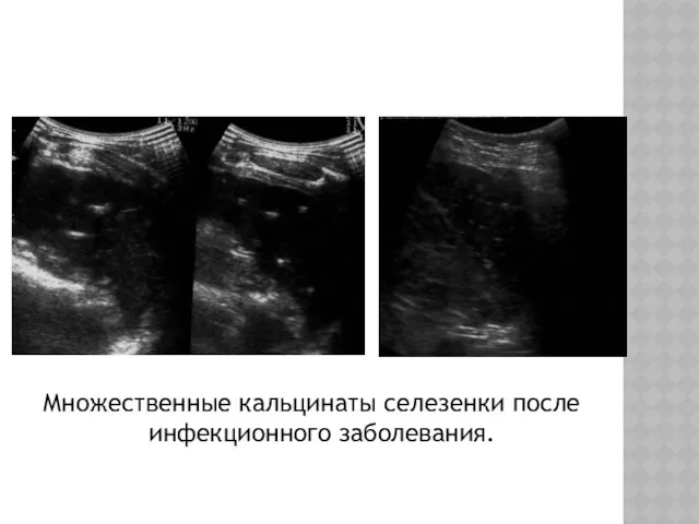 Множественные кальцинаты селезенки после инфекционного заболевания.