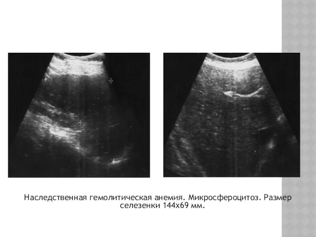 Наследственная гемолитическая анемия. Микросфероцитоз. Размер селезенки 144х69 мм.