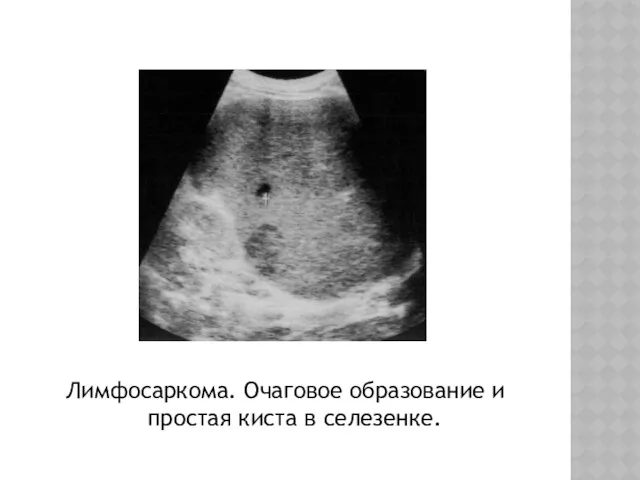 Лимфосаркома. Очаговое образование и простая киста в селезенке.