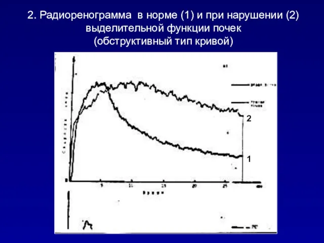 2. Радиоренограмма в норме (1) и при нарушении (2) выделительной функции почек (обструктивный