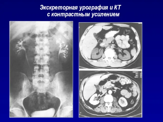 Экскреторная урография и КТ с контрастным усилением