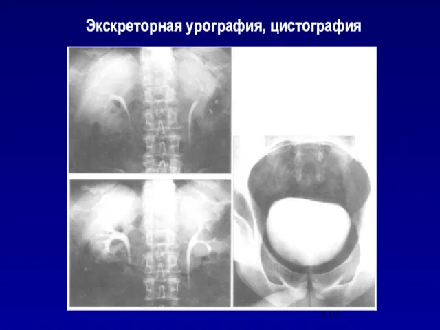 Экскреторная урография, цистография