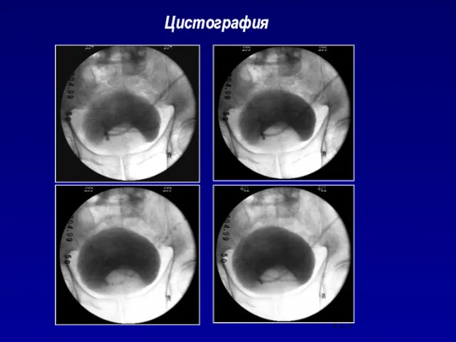 Цистография