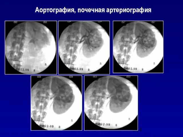 Аортография, почечная артериография