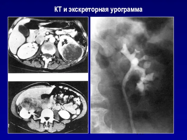 КТ и экскреторная урограмма