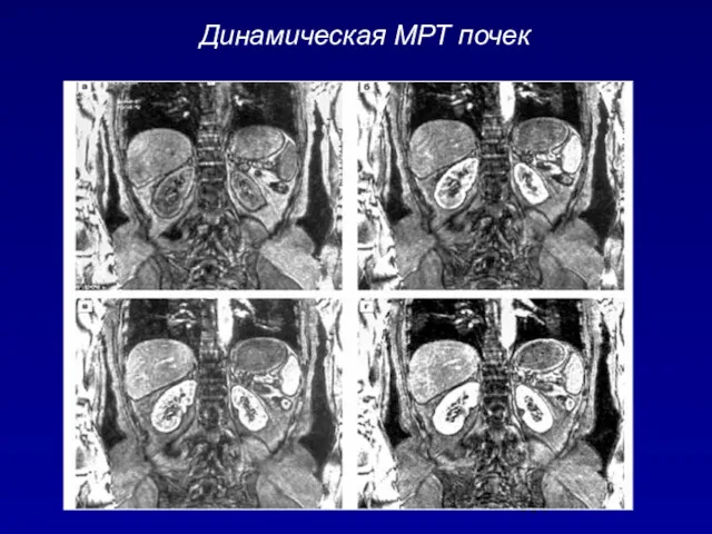 Динамическая МРТ почек