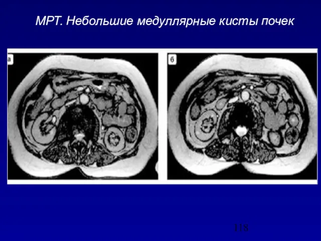 МРТ. Небольшие медуллярные кисты почек