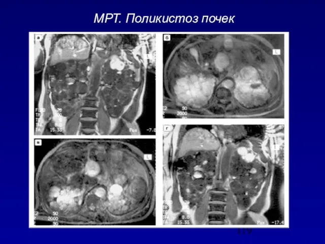 МРТ. Поликистоз почек