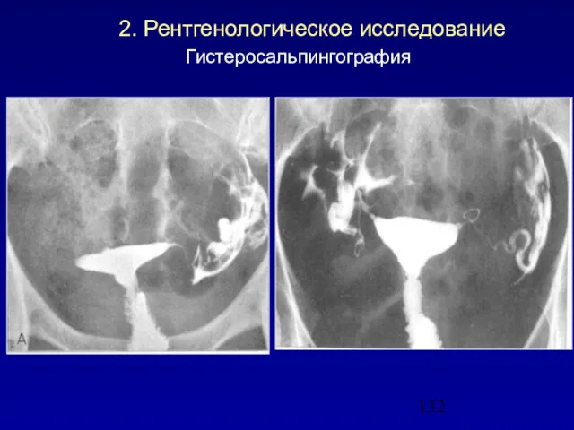 2. Рентгенологическое исследование Гистеросальпингография