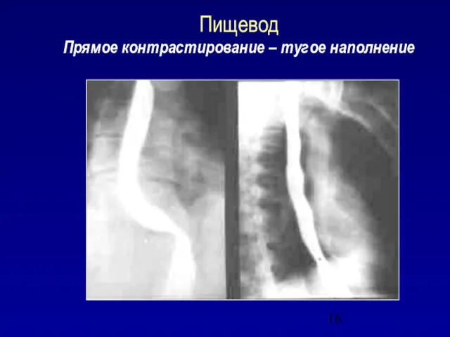 Пищевод Прямое контрастирование – тугое наполнение