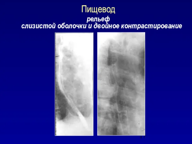 Пищевод рельеф слизистой оболочки и двойное контрастирование