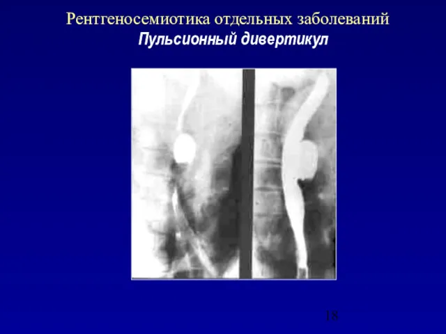 Рентгеносемиотика отдельных заболеваний Пульсионный дивертикул