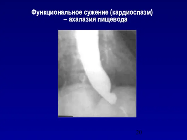 Функциональное сужение (кардиоспазм) – ахалазия пищевода