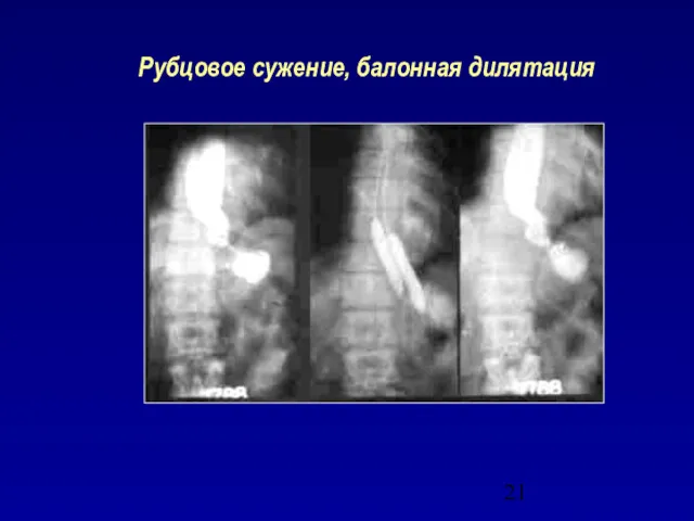 Рубцовое сужение, балонная дилятация