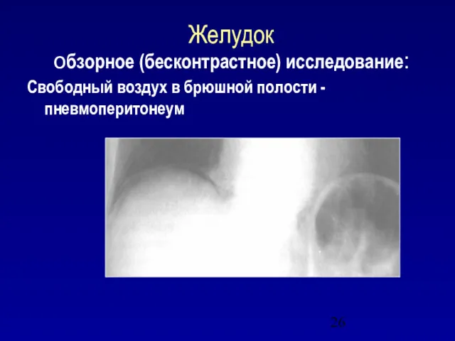 Желудок обзорное (бесконтрастное) исследование: Свободный воздух в брюшной полости - пневмоперитонеум