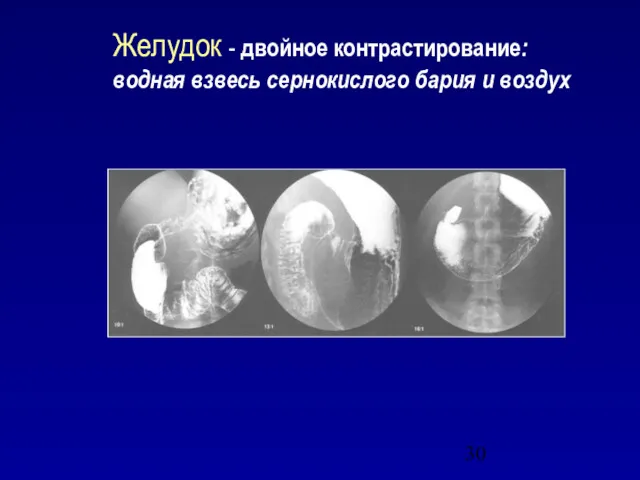 Желудок - двойное контрастирование: водная взвесь сернокислого бария и воздух