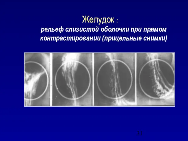 Желудок : рельеф слизистой оболочки при прямом контрастировании (прицельные снимки)