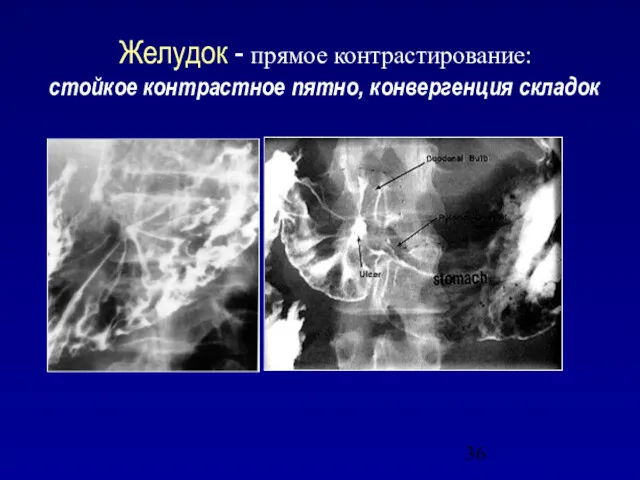 Желудок - прямое контрастирование: стойкое контрастное пятно, конвергенция складок