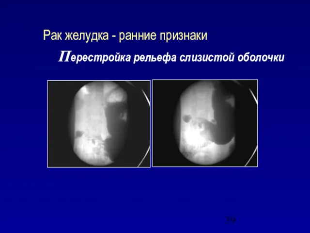 Рак желудка - ранние признаки Перестройка рельефа слизистой оболочки