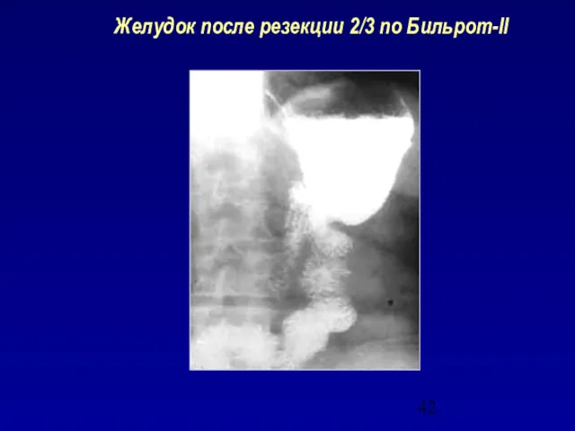 Желудок после резекции 2/3 по Бильрот-II