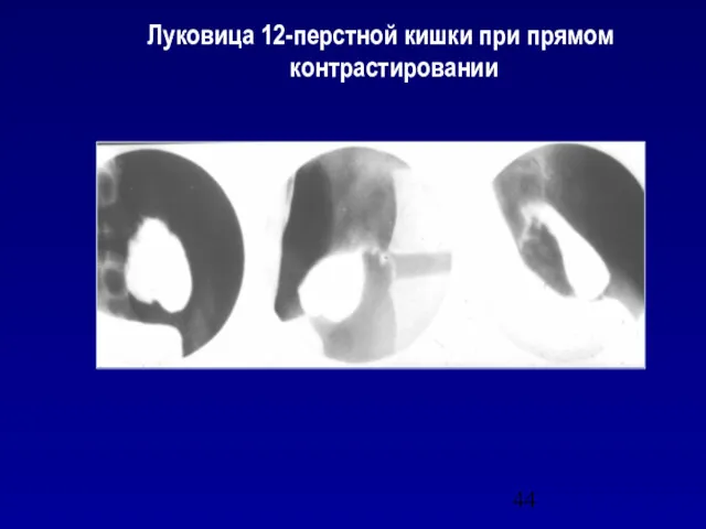 Луковица 12-перстной кишки при прямом контрастировании