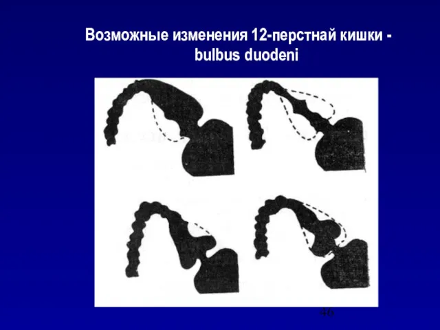 Возможные изменения 12-перстнай кишки - bulbus duodeni