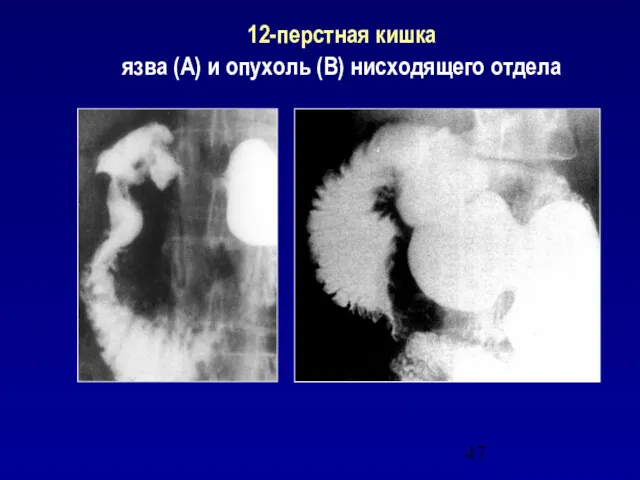 12-перстная кишка язва (А) и опухоль (В) нисходящего отдела