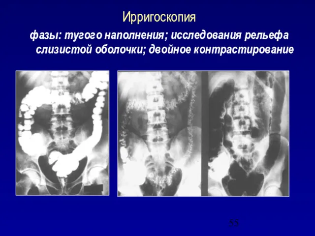 Ирригоскопия фазы: тугого наполнения; исследования рельефа слизистой оболочки; двойное контрастирование