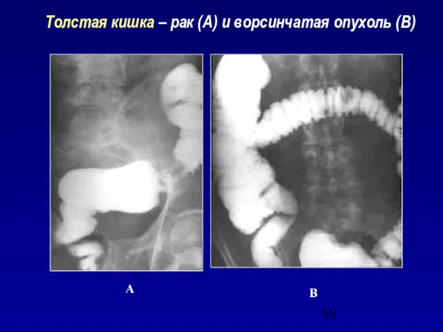 Толстая кишка – рак (А) и ворсинчатая опухоль (В) А В