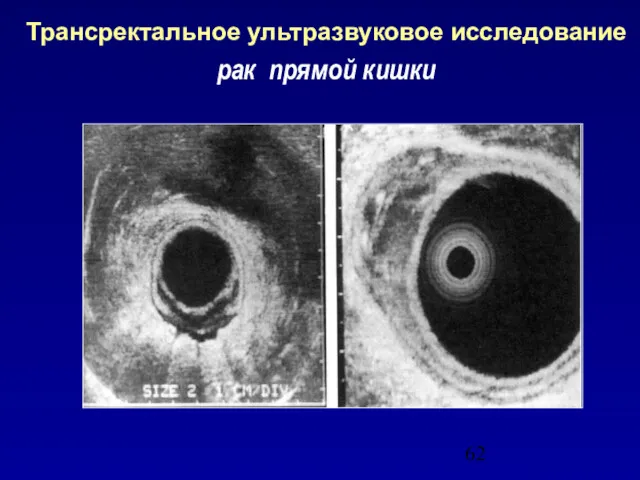 Трансректальное ультразвуковое исследование рак прямой кишки