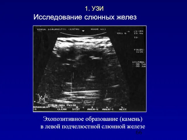 Эхопозитивное образование (камень) в левой подчелюстной слюнной железе 1. УЗИ Исследование слюнных желез