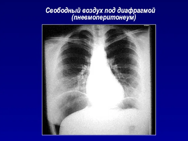 Свободный воздух под диафрагмой (пневмоперитонеум)