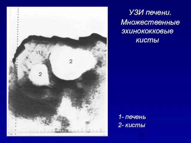 1- печень 2- кисты УЗИ печени. Множественные эхинококковые кисты