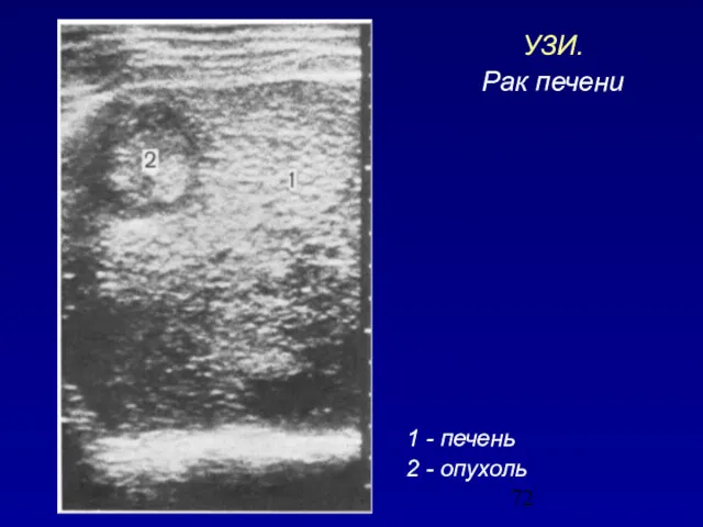 1 - печень 2 - опухоль УЗИ. Рак печени